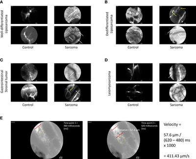 Human intravital microscopy in the study of sarcomas: an early trial of feasibility
